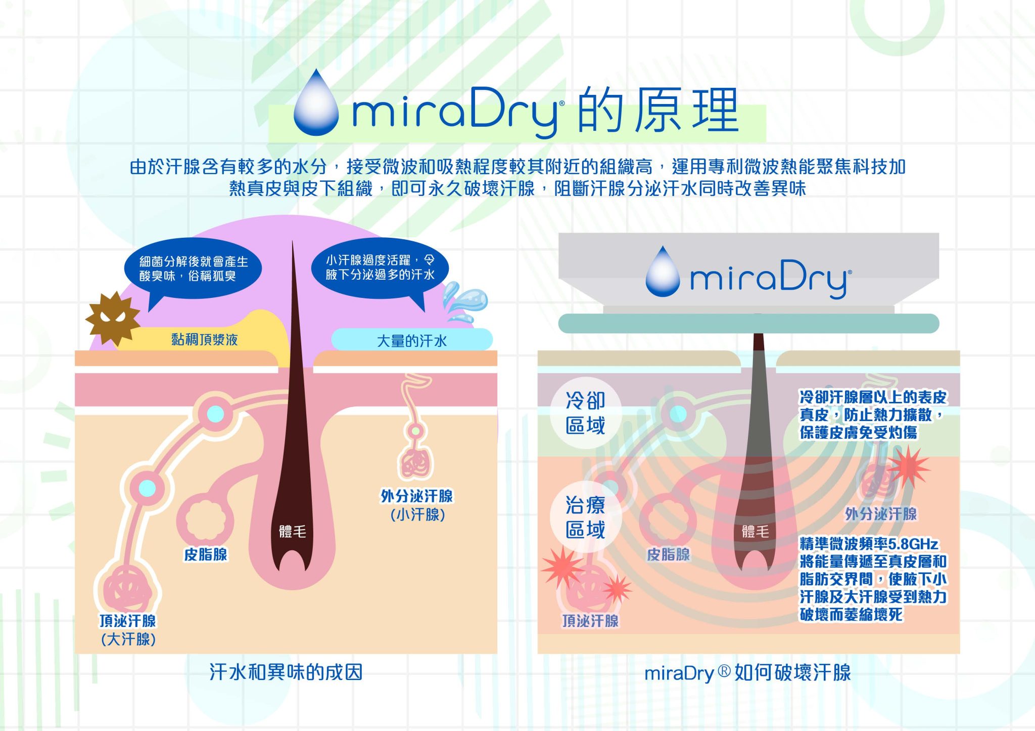 miraDry無創治療原理圖解，顯示微波熱能如何精準破壞汗腺，同時冷卻系統保護皮膚表層安全。