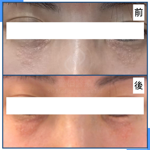 譽柏醫療-客戶見證-Syringoma-01