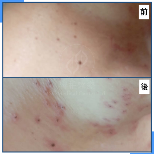 譽柏醫療-客戶見證-Warts02